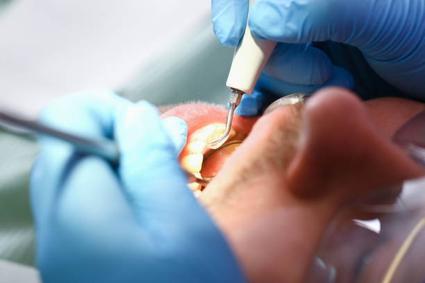 Best Emergency Dental Extractions in Elmhurst, IL