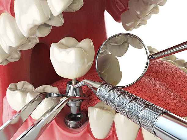 Best Broken or Cracked Tooth Emergency Dentist in Elmhurst, IL