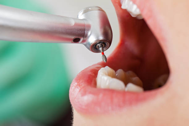 Best Emergency Dentist for Lost Fillings or Crowns in Elmhurst, IL